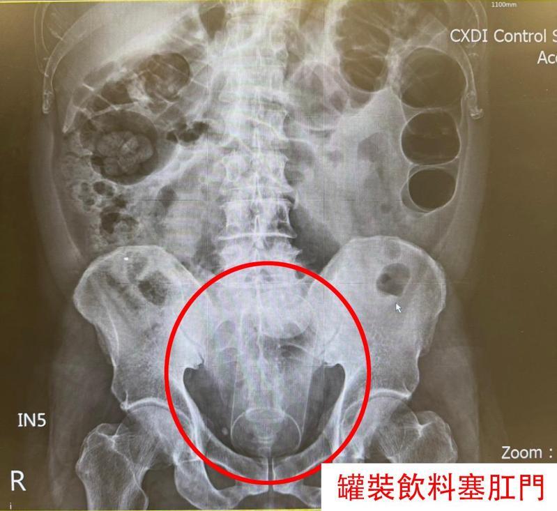 男子將果汁罐塞入肛門內,因罐身平滑,一度難以取出。圖/中國醫藥大學新竹附設醫院提供 男子將果汁罐塞入肛門內,因罐身平滑,一度難以取出。圖/中國醫藥大學新竹附設醫院提供