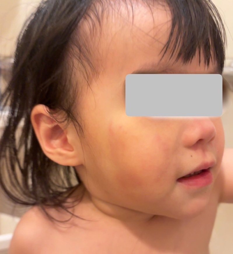 女童臉上有明顯疑似咬痕。圖／市議員張嘉玲提供