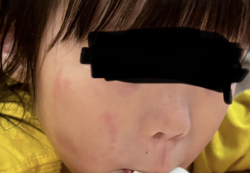 女童臉上有明顯疑似咬痕。圖／市議員張嘉玲提供