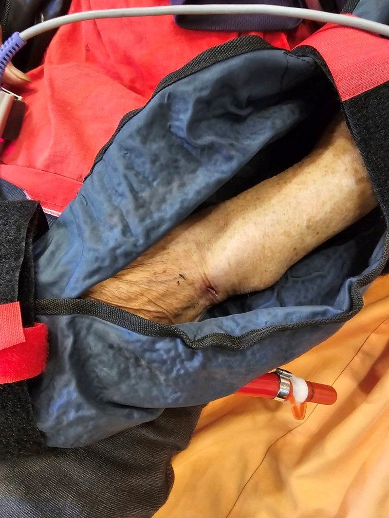 88歲羅姓老婦人昨天下午在苗栗縣銅鑼火車站附近,因突然竄出的犬隻竄出受到驚嚇跌倒,造成左手、左側股骨骨折,送醫開刀治療。圖/苗栗縣政府消防局提供 88歲羅姓老婦人昨天下午在苗栗縣銅鑼火車站附近,因突然竄出的犬隻竄出受到驚嚇跌倒,造成左手、左側股骨骨折,送醫開刀治療。圖/苗栗縣政府消防局提供